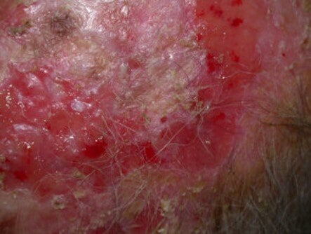 Erosive Pustular Dermatosis3