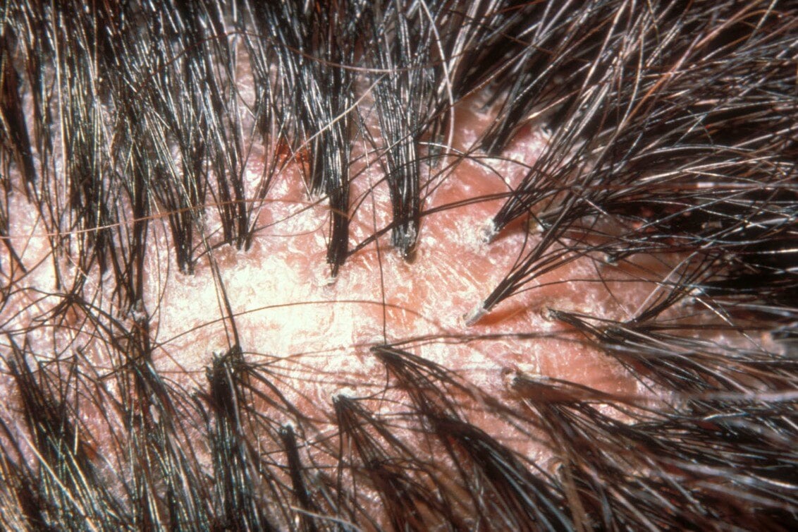 Folliculitis Decalvans2