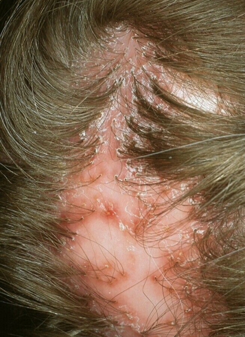 Folliculitis Decalvans3